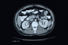 Symptoms of a Partial Bowel Blockage