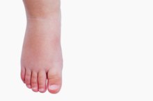 Ankle Swelling in Children