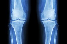 Top Bone Diseases