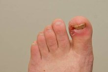 Symptoms of Diabetes in the Feet