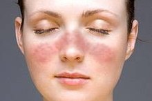 What Are the Causes of Face Rash?