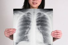 是什么导致肺部的疤痕？
