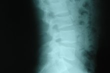 椎骨椎间盘的肠和膀胱并发症