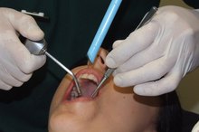 Dental Extraction Side Effects