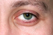 What Are the Causes of Eye Puffiness & Swollen Fingers?