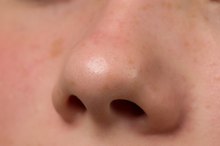 What Causes Pimples in Your Nose?