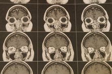 What Are the Causes of Brain Atrophy?