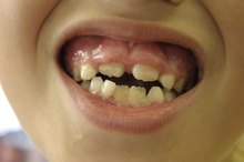 What Vitamin Deficiencies Cause Swollen Gums?