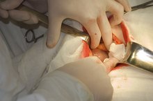 Post Operative Complications of Abdominal-Hernia Surgery
