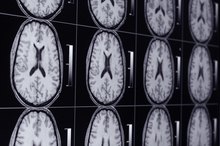 Can I Eat Before an MRI Brain Scan?