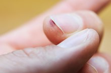 如何去除指甲下常见的疣