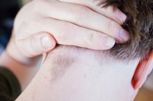 如何治疗头皮内生毛发