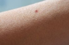 How to Remove Ingrown Arm Hair