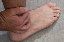How to Treat a Swollen Foot From an Insect Bite