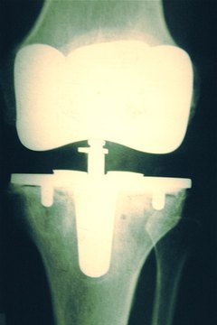 Knee surgery replacement tissue uses the interference type screw.