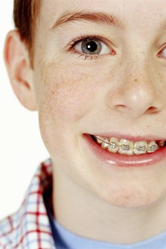 Digital Vision/Digital Vision/Getty Images Braces can easily cost $5,000 or more.