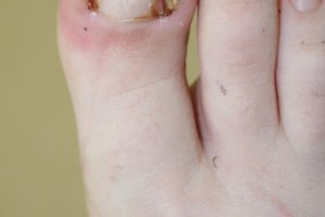 Cuál es el tratamiento para padrastros y uñas encarnadas