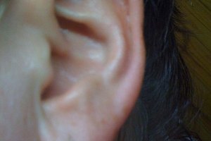 Síntomas de la infección del lóbulo de la oreja