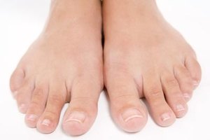 Cómo aplicar aceite del árbol del té para los hongos de las uñas