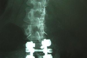 Ejercicios para la osteoporosis de columna