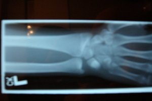 Anatomía de los ligamentos del antebrazo