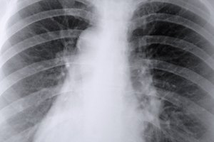 ¿Cuáles son las causas de los depósitos de calcio en los pulmones?