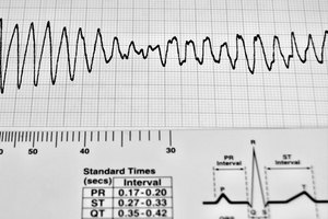 Los electrolitos y arritmias cardíacas