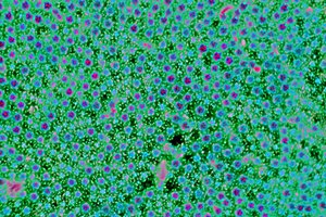 Dieta para el sobrecrecimiento bacteriano en los intestinos