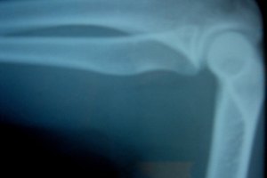 Ejercicios para la osteoporosis y osteopenia