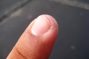 Líneas negras en las uñas y cardiopatía