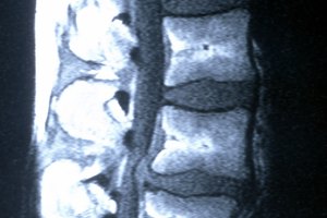 ¿Puedes hacer ejercicio si tengo hernias en los discos L4 y L5?