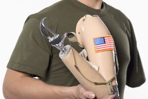 Man holding prosthetic arm