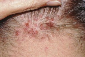 Cómo tratar acné queloide en la nuca