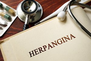 Herpangina en adultos