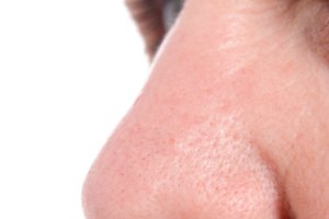 Cómo deshacerse de las arrugas en la nariz