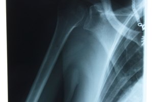 Rehabilitación de brazo y hombro después de una fractura de húmero