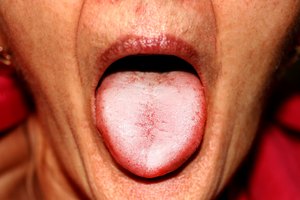 Cómo deshacerte de los granos blancos en la lengua