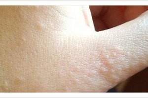 Granitos en las manos: causas, diagnóstico y tratamiento