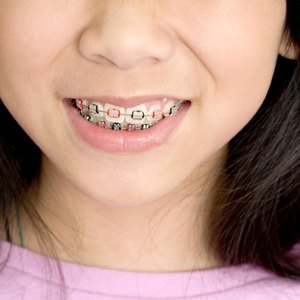 How to Get Free Braces in Los Angeles