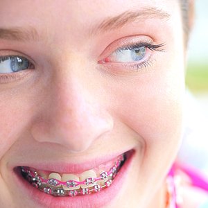 How to Get Free Braces