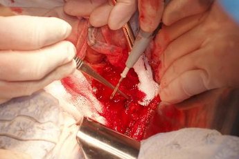 Pectus excavatum can be fixed only by surgery.