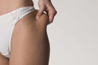 Fat can accumulate anywhere, including the belly, thighs and hips.