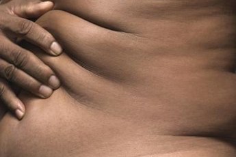 Losing more than 100 pounds can lead to irreversible stretching of the skin.