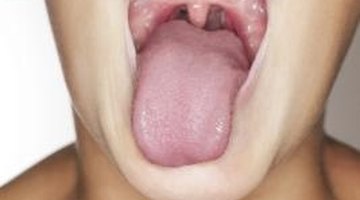 Fronting is a speech issue related to the position of the tongue in the mouth.