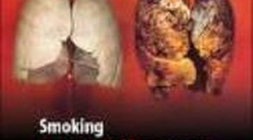 A healthy lung and a burnt smoker's lung
