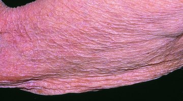 ¿Cuáles son las causas de adelgazamiento de la piel?