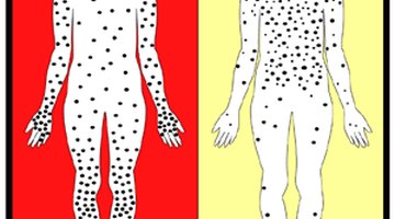 Difference in rash distribution between smallpox and chickenpox