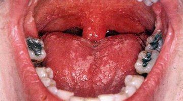 Oral Thrust; http://www.medical-look.com/Mouth_diseases/Oral_thrush.html