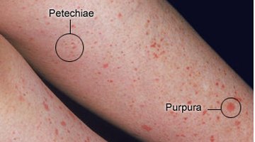 Petechiae or purpura on the skin is a sign of low platelets.