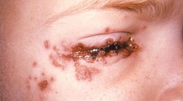 Herpes around the skin of the eye